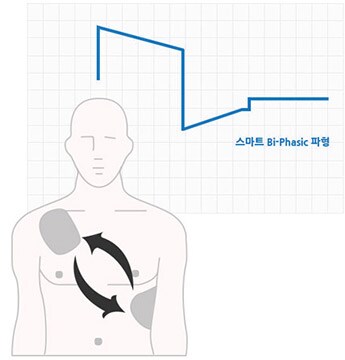 Bi-Phasic 파형