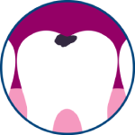 dental-caries