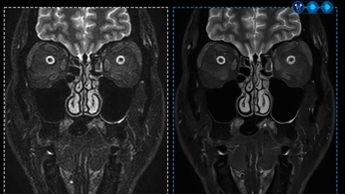 philips unveil mr smartspeed precise with dual ai engine asset